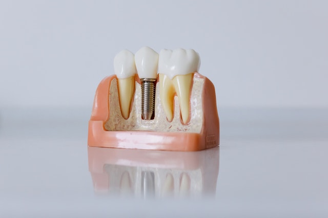 Dental Implants North Vancouver | Peak Dental Arts