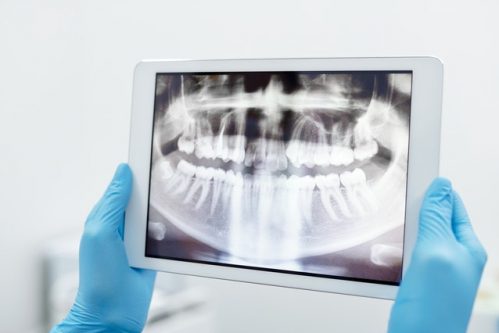 Dentures and Partial Dentures North Vancouver | Peak Dental Arts Clinic